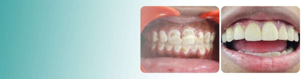 Before and after dental treatment at Dentem Clinic