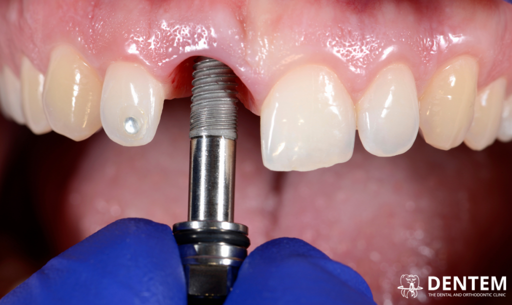 Causes of Dental Implant Failure - Dentem Clinic