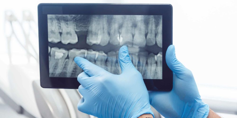 Dental OPG