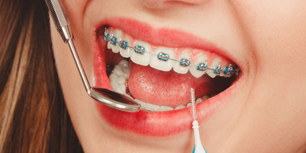 Braces in Delhi
