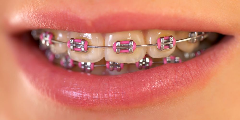 Braces in Delhi