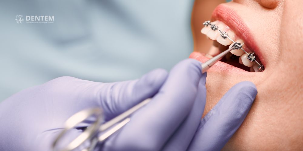 Braces in Delhi