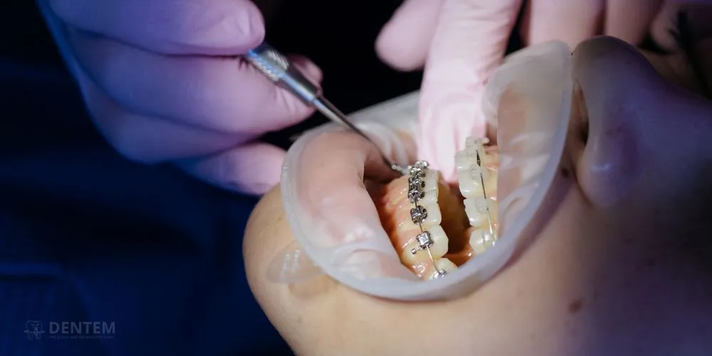 braces treatment in Delhi