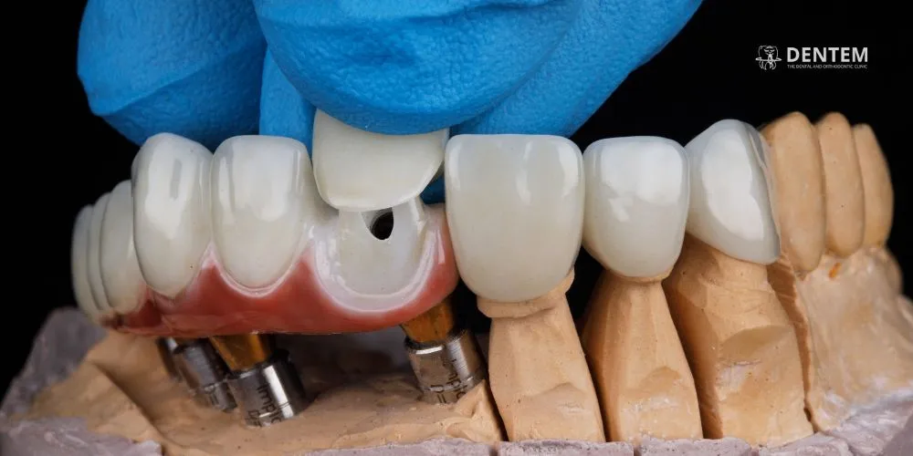 Dental Veneers and Laminates in Delhi