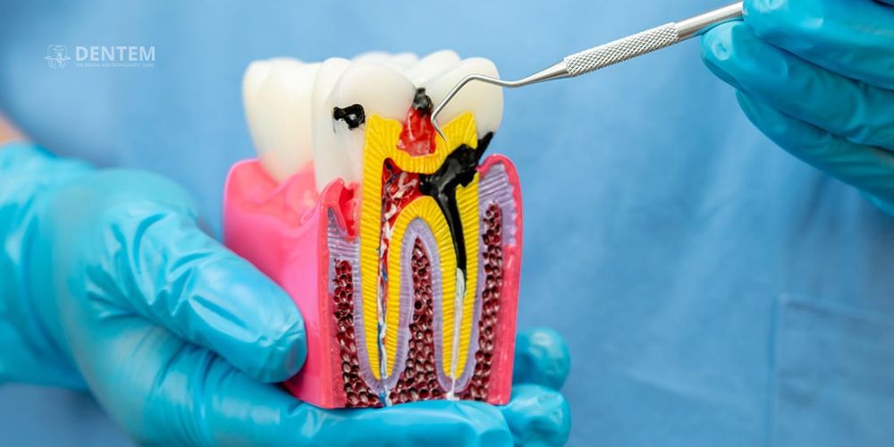 Endodontist in Delhi