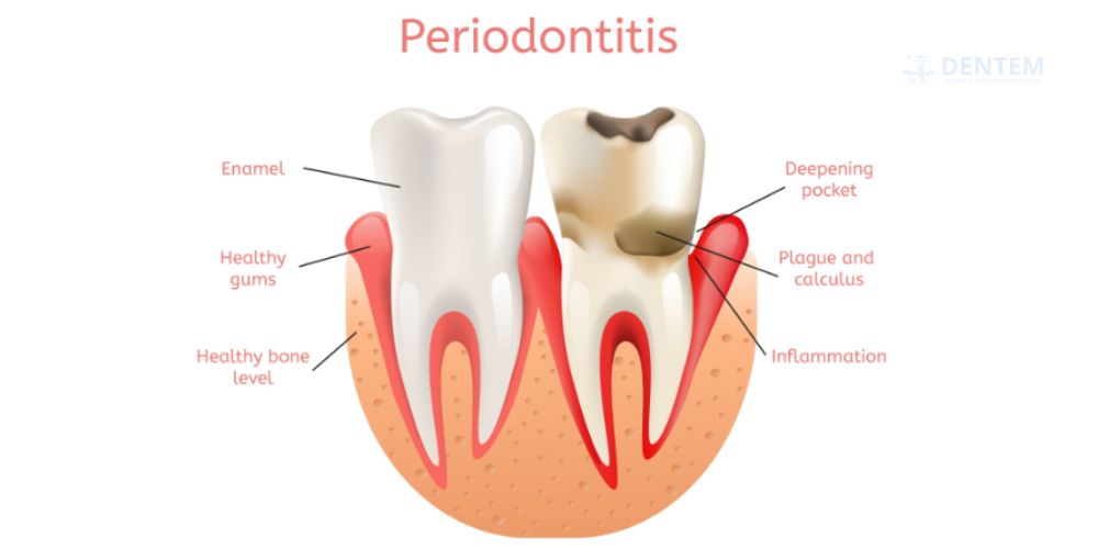 Periodontist in Delhi