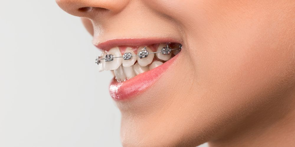 Braces in Delhi