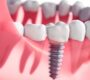 dental implant 1 90x80