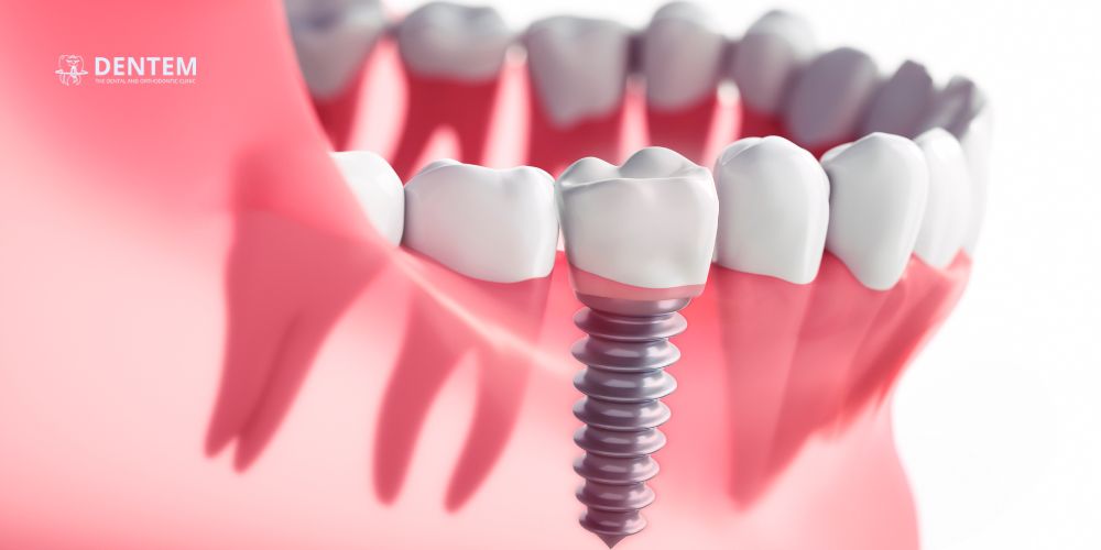 Dental Implants in Delhi