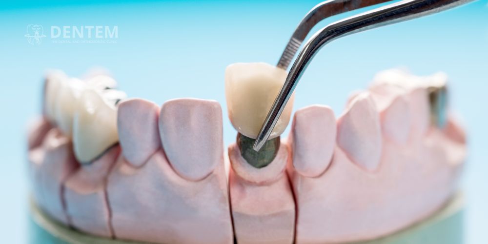 Prosthodontics in Delhi
