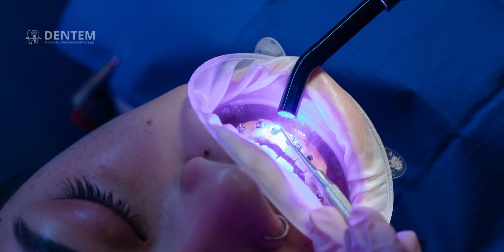 Braces Cost in Delhi