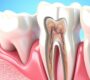 Root Canal Treatment 90x80