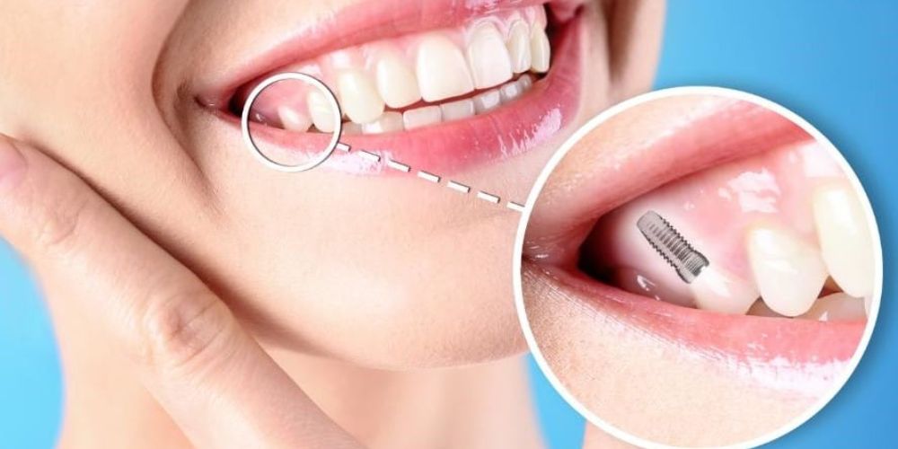 Dental Implants in Delhi