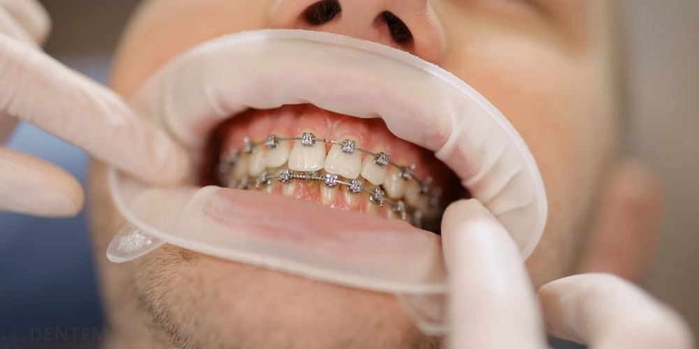 Orthodontist in Delhi