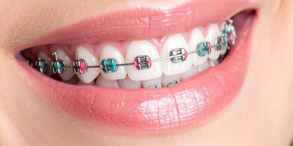 clear braces in Delhi