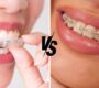 Invisalign vs Toothsi 90x80