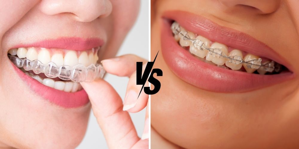 Invisalign vs Toothsi