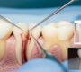 Root Canal Treatment 90x80