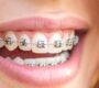 Orthodontic Treatment 90x80