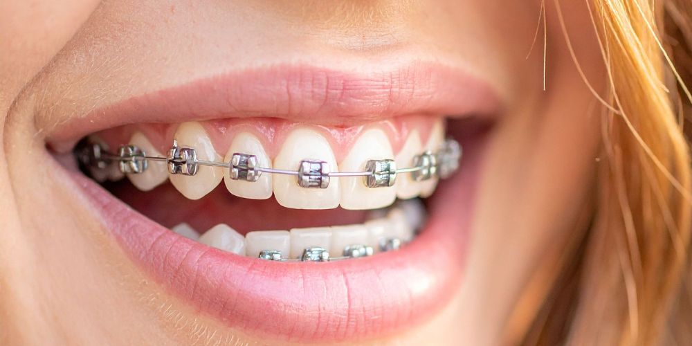 Orthodontic Treatment in Gurgaon