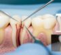 Root Canal Treatment 90x80