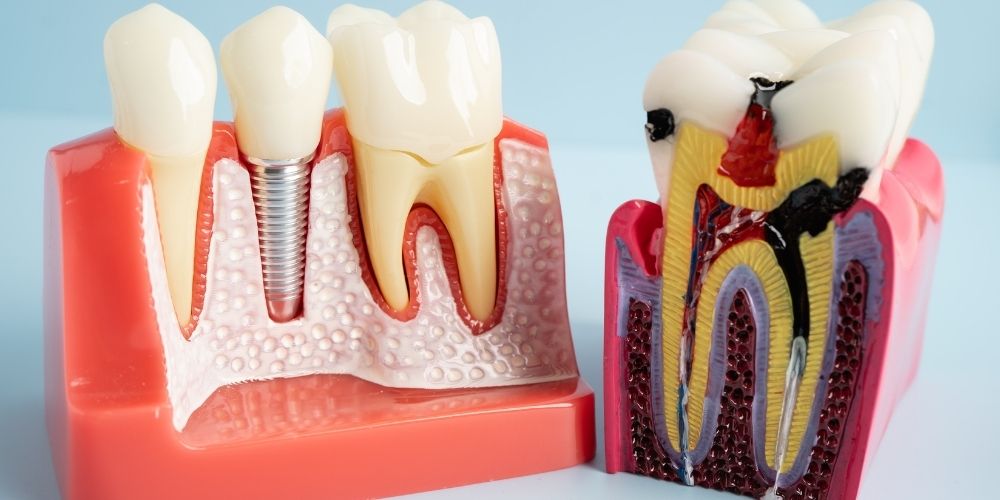Root Canal Treatment in Delhi