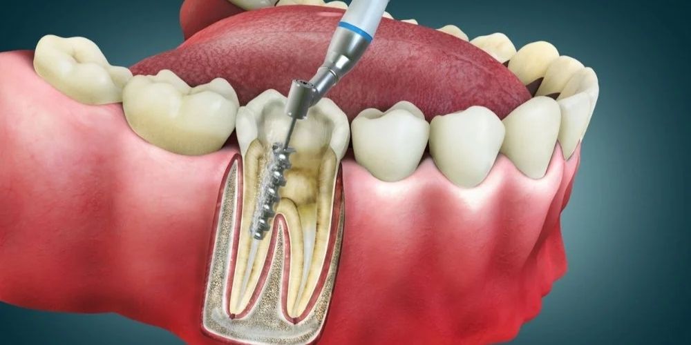 Root Canal Treatment in Delhi