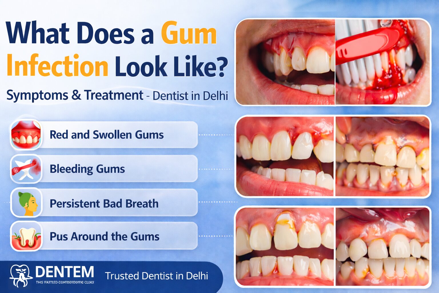 Symptoms of gum infection in Delhi