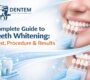 Teeth whitening in Delhi 90x80