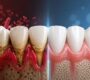 gum disease treatment in Delhi 90x80