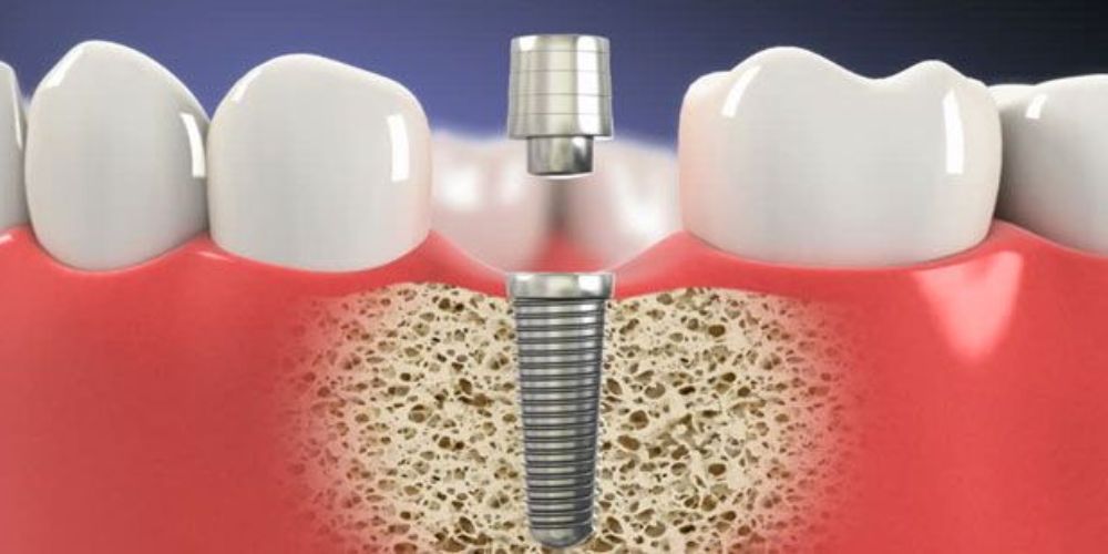 Dental implants in Delhi