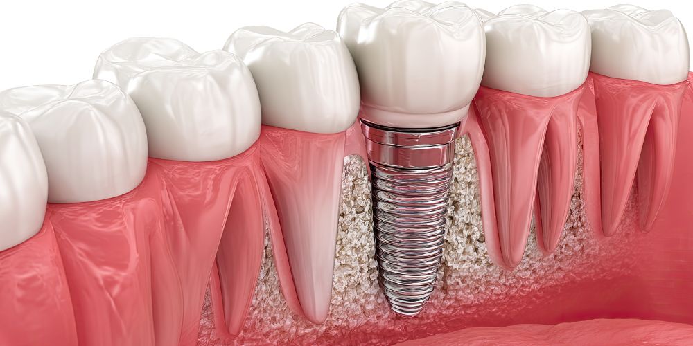 Dental Implants in Delhi