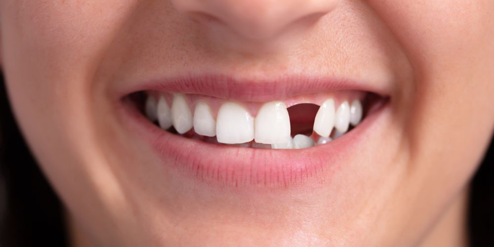 Missing Tooth