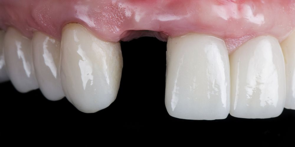 Missing Tooth