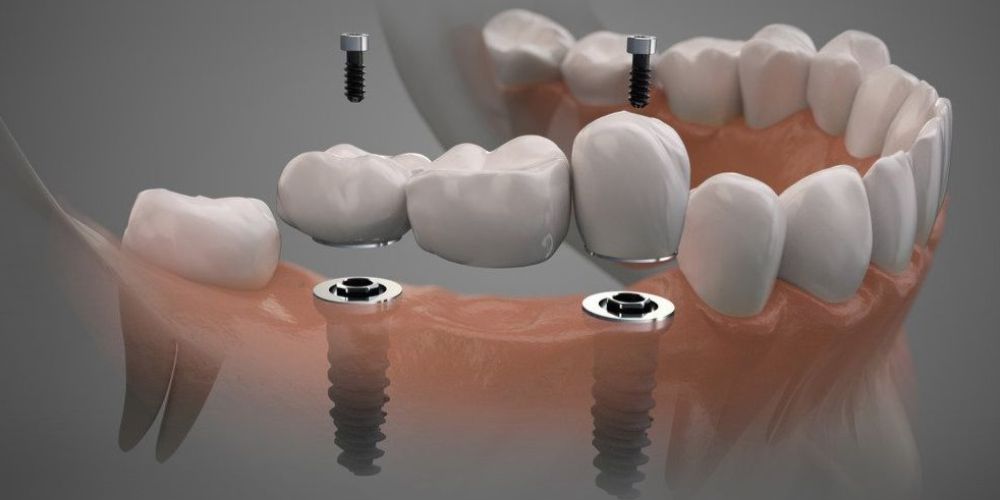 Dental Implants
