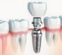 Dental Implants 90x80