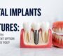 Dental implants vs dentures comparison 90x80