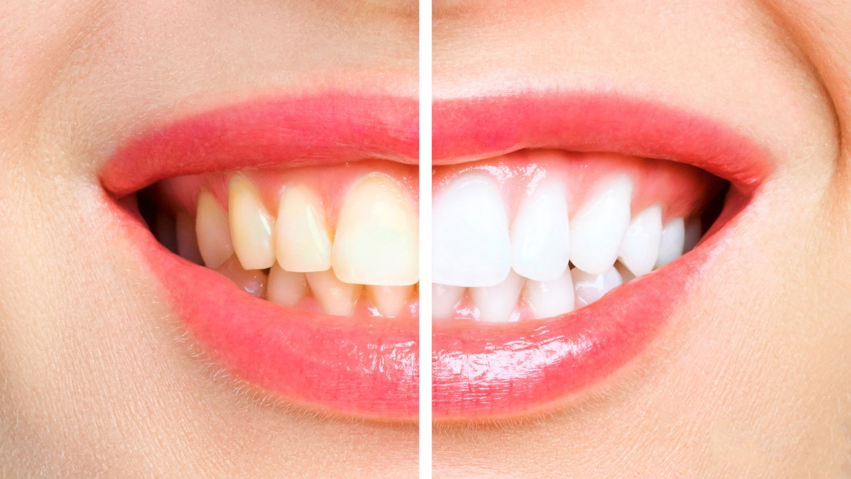 Teeth-Whitening
