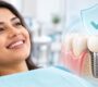 Dental Implants  90x80