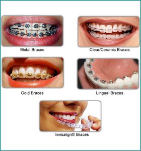 Braces treatment in South delhi