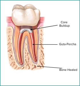 Root Canal Treatment (2)