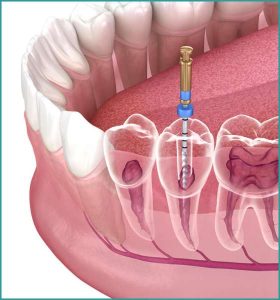 Root Canal Treatment (3)