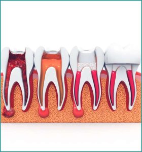 Root Canal Treatment (5)