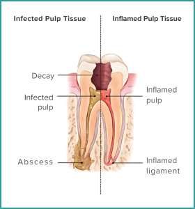 Root Canal Treatment